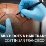 How much does a Hair Transplant Cost in San Francisco