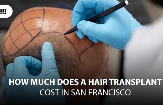 How much does a Hair Transplant Cost in San Francisco